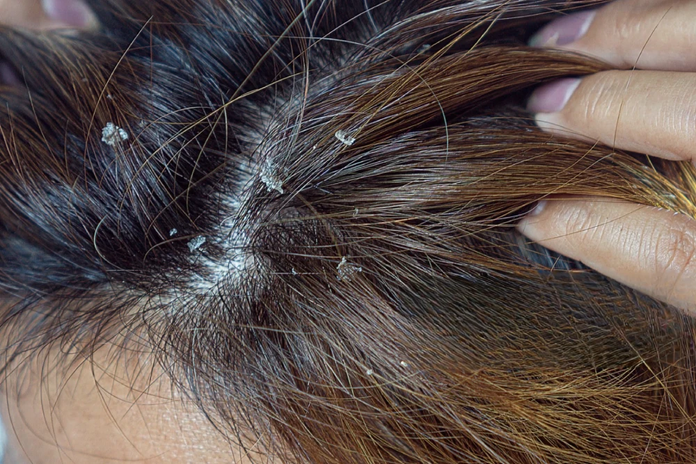 Understanding the Root Causes of Dandruff