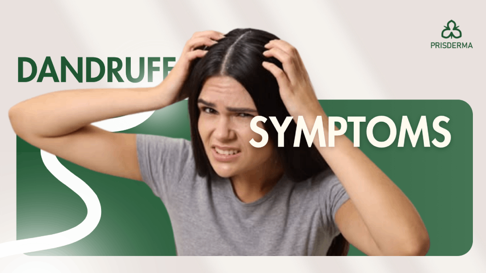 Dandruff Symptoms